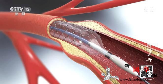 支架降价为何专家却对一些患者说“没必_支架-处方-康复-