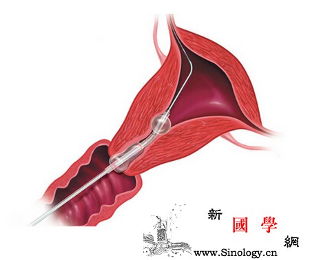 输卵管通而不畅可以试试这个办法治疗_输卵管-怀孕-腹腔镜-手术-孕前检查