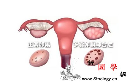 多囊性卵巢_卵泡-肾上腺-排卵-卵巢-不孕不育
