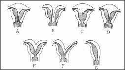 纵隔子宫_纵隔-胎位-术后-分娩-怀孕准备