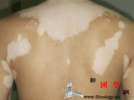 白癜风传染吗_黑色素-表皮-色素-白斑-遗传优生