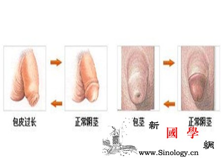 割包皮_包茎-龟头-包皮-术后-两性知识