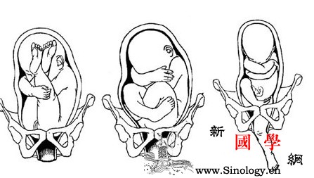 这4种不良胎位会造成难产_枕骨-胎位-骨盆-难产-