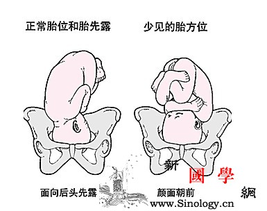 分娩方式主要由胎儿的位置决定_产道-屈曲-剖腹产-分娩-