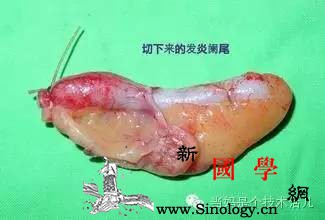 这种常见“小病”似乎不值一提却能在暗中导致_输卵管-脓肿-阑尾炎-殃及-不孕不育