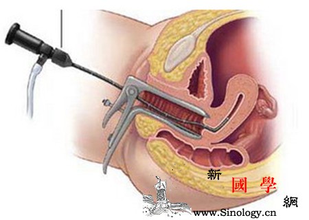 输卵管造影怎么做_造影-结膜-子宫颈-输卵管-孕前检查