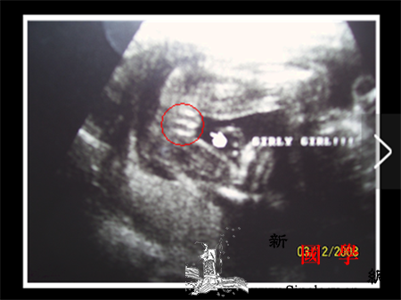 男孩女孩b超区别图_则是-区别-男孩-宝宝-生男生女