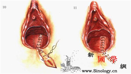 会阴侧切多久恢复该如何护理_会阴-该如何-术后-产后-