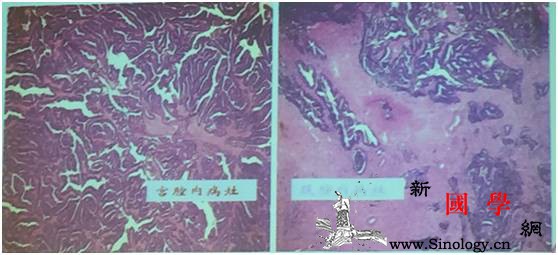 专家支招|子宫内膜就“生病”了还能生娃_病灶-增生-病理-生育-孕前检查