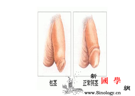 包茎的症状有哪些_后天性-包茎-排尿-包皮-两性知识