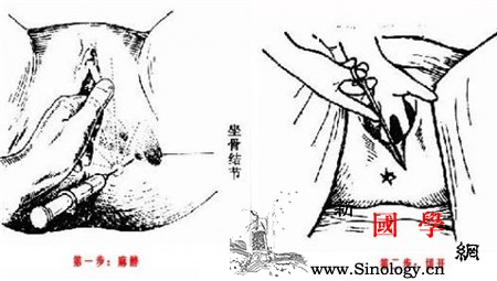 顺产侧切是切哪里_拆线-顺产-会阴-产妇-