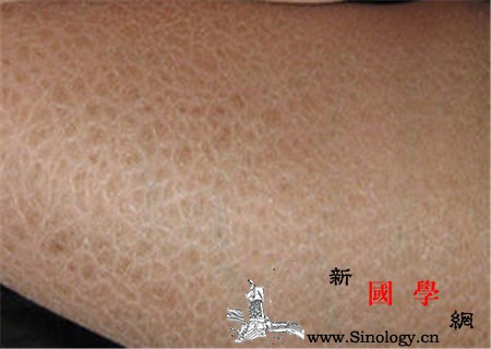 鱼鳞病是怎么引起的_角化-遗传病-染色体-隐性-遗传优生