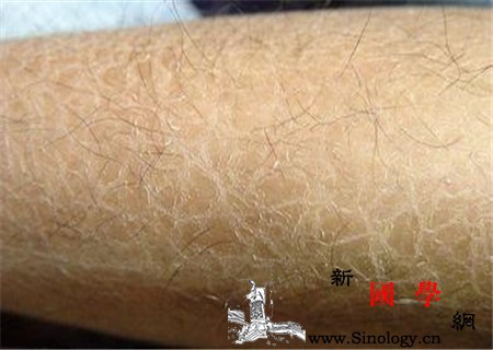 鱼鳞病是什么病_鳞屑-角化-皮疹-遗传性-遗传优生
