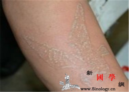 鱼鳞病可以纹身吗_角化-还会-鱼鳞-鱼鳞病-遗传优生