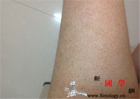 鱼鳞病会痒吗_鱼鳞-瘙痒-鱼鳞病-分泌-遗传优生