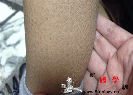 鱼鳞病长大后会好吗_鳞屑-角化-鱼鳞-后会-遗传优生