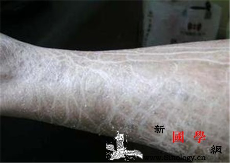 鱼鳞病分几种_肘窝-鳞屑-红皮-角化-遗传优生