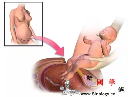 脐带脱垂怎么办_胎膜-脐带-产妇-分娩-