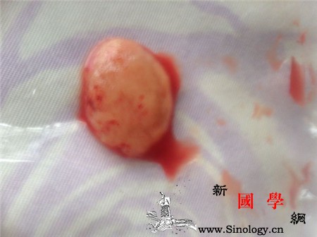 滑胎流出来的是什么_血块-胚胎-妊娠-胎儿-