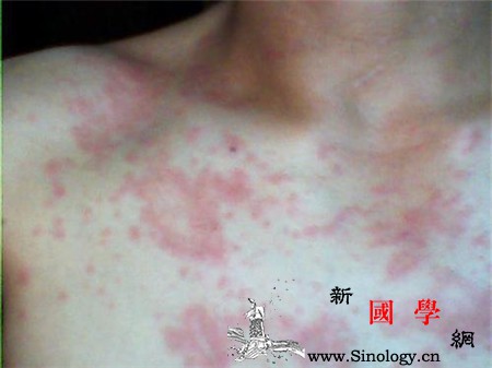 艾滋病皮疹会痒吗_皮疹-艾滋病毒-抗病毒-艾滋病-两性知识