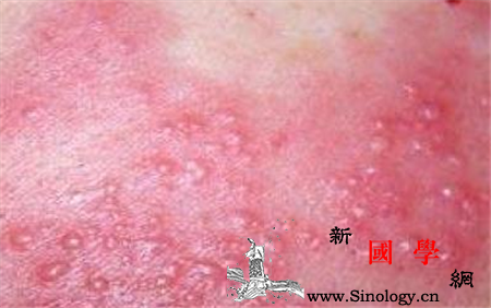 艾滋病皮疹是全身还是局部_皮疹-艾滋病毒-出现在-艾滋病-两性知识