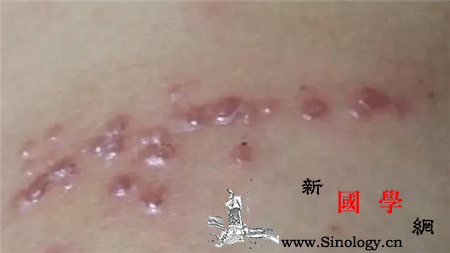 全身长疹子是艾滋病吗_疹子-皮疹-艾滋病毒-黏膜-两性知识