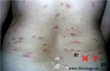 艾滋病红点是什么样子的呢_消化道-腹泻-共用-用具-两性知识