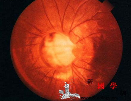 早产儿视网膜病变能治好吗_酪氨酸-早产儿-视网膜-病变-