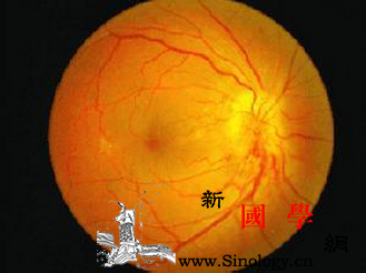早产儿视网膜病变筛查指南_阈值-早产儿-视网膜-病变-
