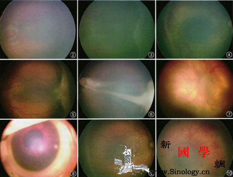 早产儿视网膜病变分期_黄斑-早产儿-增殖-视网膜-