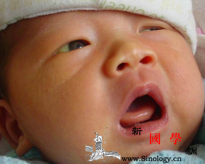 新生儿生理性黄疸的原因_糖醛酸-胆红素-黄疸-排泄-