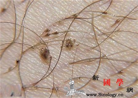 孕妇得了阴虱怎么办_阴虱-虫卵-阴毛-孕妇-