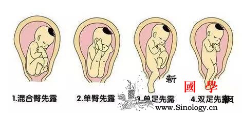 胎儿臀位一定要剖宫产吗？_胎膜-胎位-骨盆-胎盘-