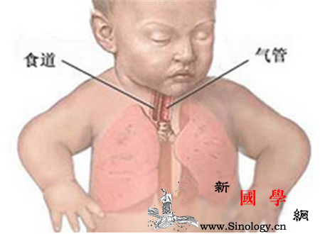 新生儿肺不张的原因_肺泡-表面张力-分泌物-支气管-