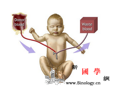 新生儿溶血病换血疗法是什么_光疗-胆红素-溶血-红细胞-