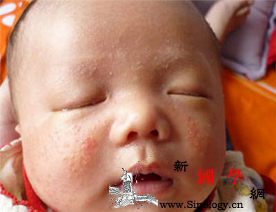 新生儿湿疹和痱子的区别_丘疹-痱子-皱褶-湿疹- ()