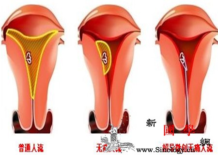 可视无痛人流术是什么_无痛-妊娠-术后-子宫-