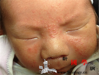 新生儿痤疮会留疤吗？_丘疹-皮疹-结节-囊肿-