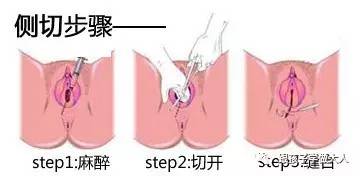 分娩时如果不必要别做会阴侧切！会对女人会阴造_推挤-会阴-会对-胎儿-