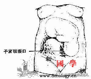 分娩出现这情况就要摘除女人最重要器官！一辈子_摘除-分娩-子宫-破裂-