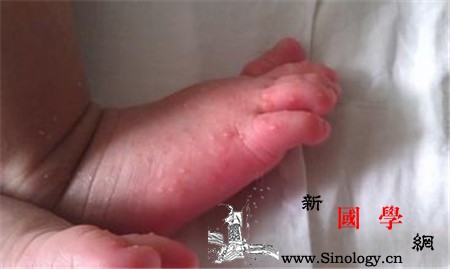新生儿秋季脚上长水泡怎么回事_水泡-湿疹-手足-脚上-
