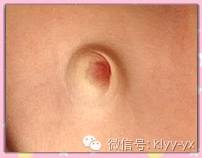 宝宝脐部突然鼓起请小心它！_胶布-哭闹-病症-预防-