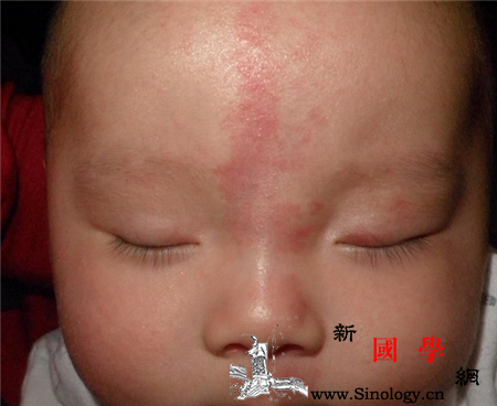 新生儿鲜红斑痣怎么办_光敏剂-避光-结痂-红斑-