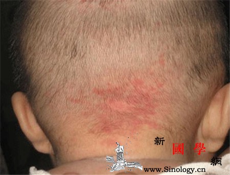 新生儿斑痣的特点_光敏剂-卟啉-抽风-色斑-