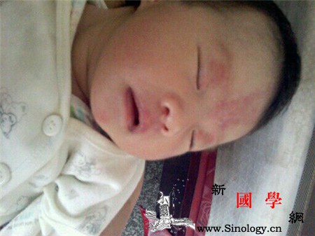 新生儿鲜红斑痣的危害_累及-红斑-色素-出血-