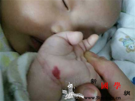 新生儿血管瘤怎么消除_激素-局部-血管-消除-