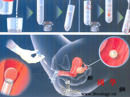 人工授精的成功率不孕不育夫妻需知_授精-针头-精液-宫颈-不孕不育