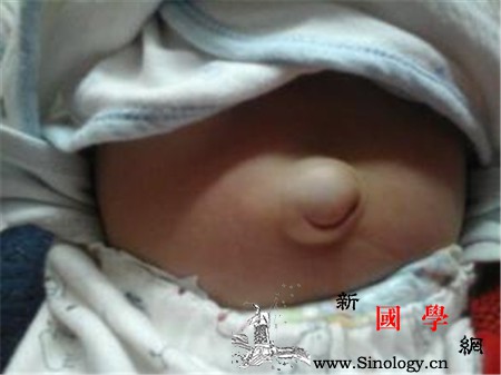 新生儿肚脐突出是怎么回事_肠管-绞痛-相关文章-肚脐-