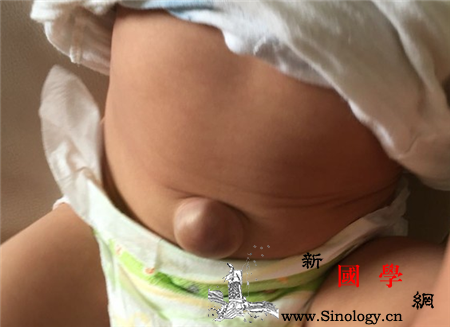 新生儿有脐疝怎么办_相关文章-肚脐-直径-皮肤-