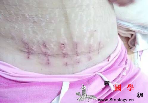 剖宫产后生二胎怀孕4月子宫破裂剖腹产妈妈_头胎-子宫-怀孕-医院-